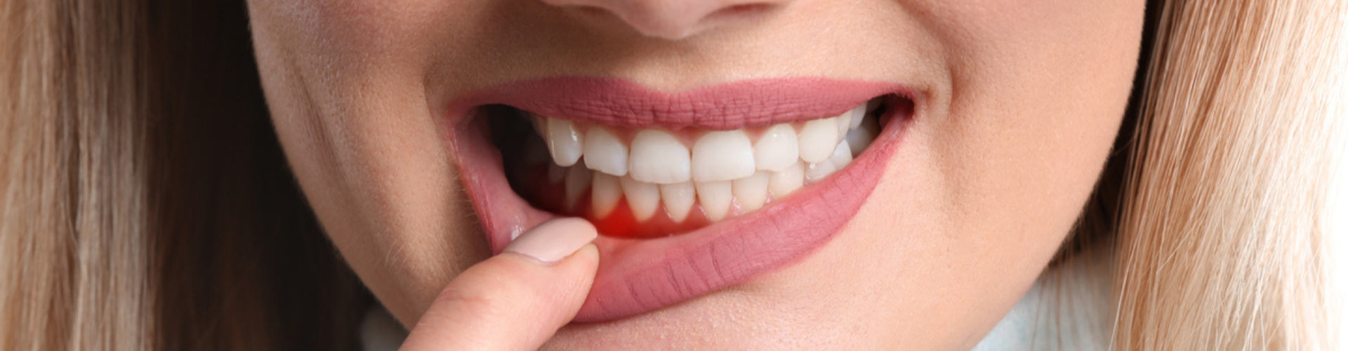 Close-up of a woman smiling while pulling down her lip to show her irritated gums.